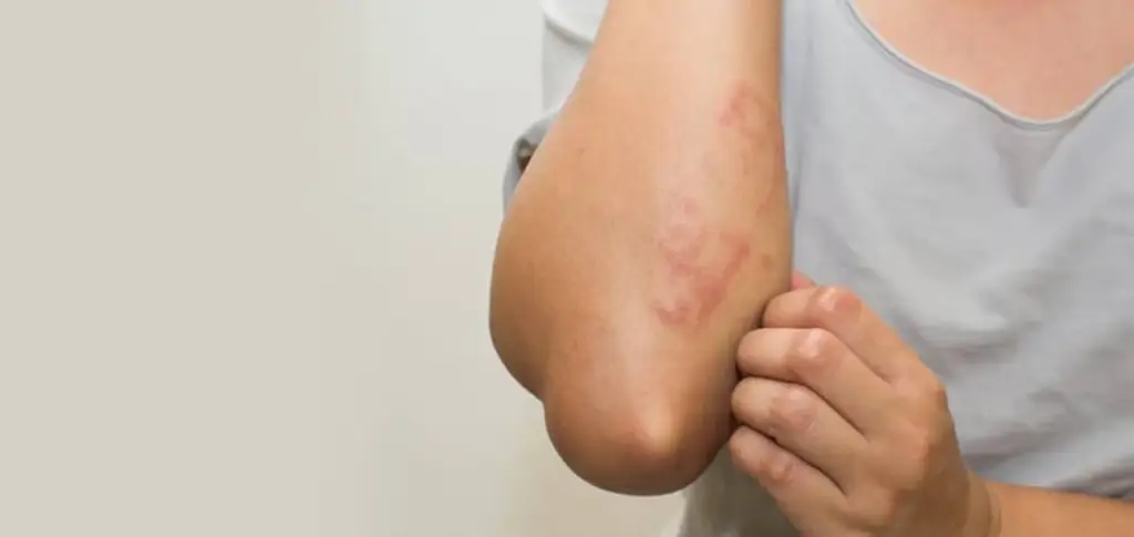 Symptoms of Seasonal Allergies