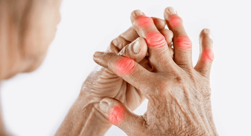 Symptoms of Arthritis