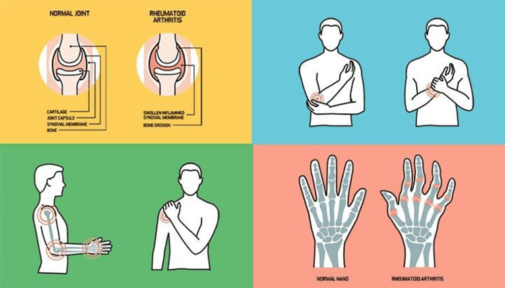 Causes of Arthritis