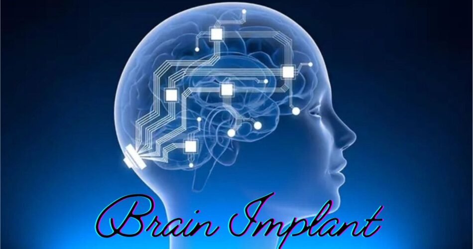 Brain Implant