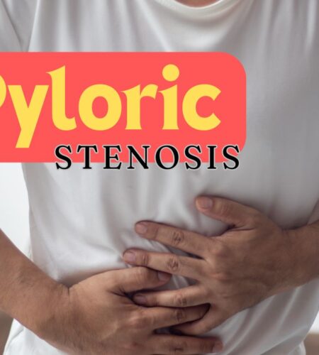 Pyloric Stenosis Causes and Treatment