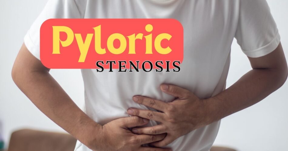 Pyloric Stenosis