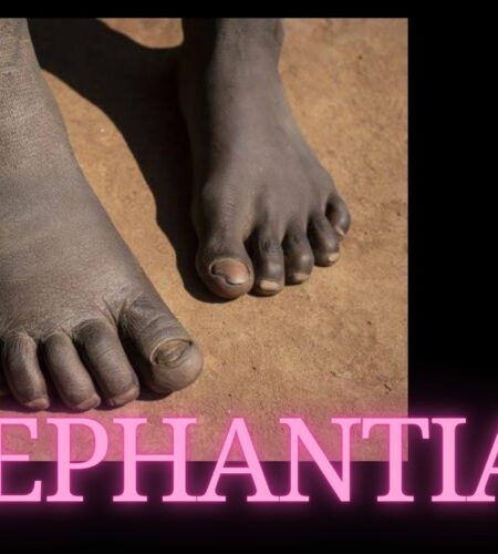 Elephantiasis Treatment and Management