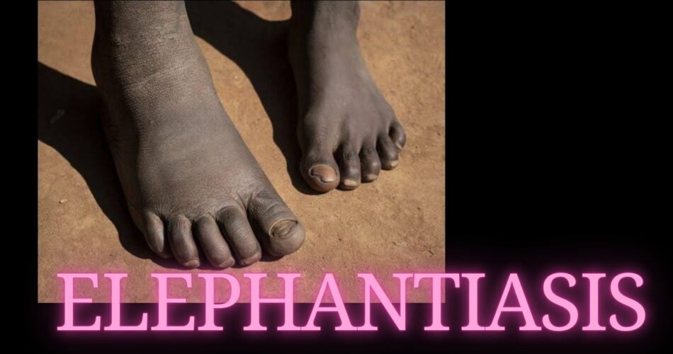 Elephantiasis