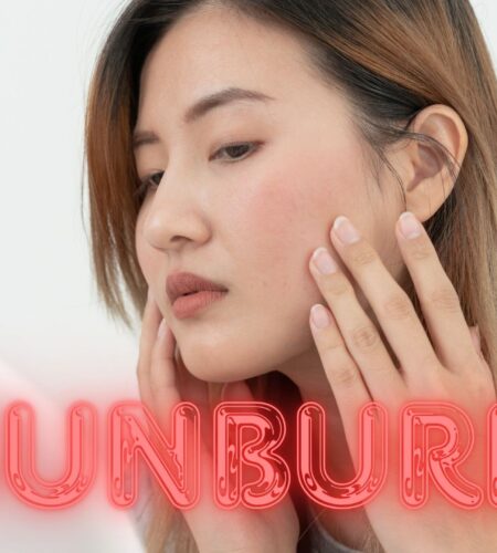 Sunburn Causes and Prevention